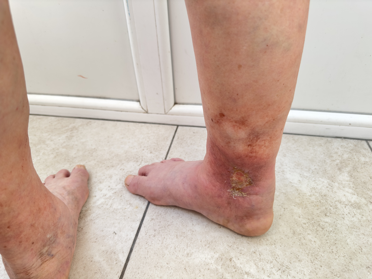 Lower legs and ankles showing swelling and skin discoloration associated with chronic venous insufficiency that is often misdiagnosed